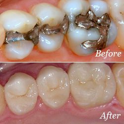 Tooth Colored Fillings in Glendale, AZ