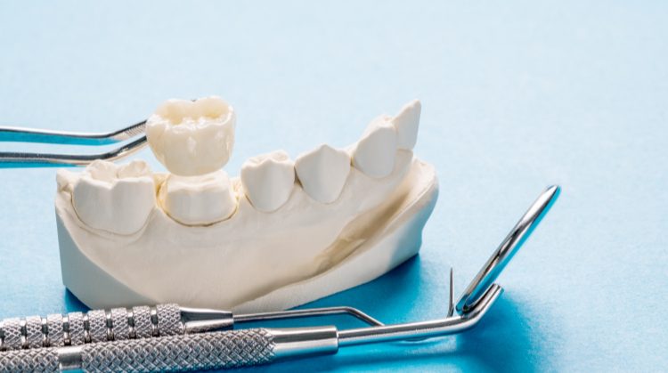 Dental crown model with tools at Palo Verde Smiles, Glendale, AZ.
