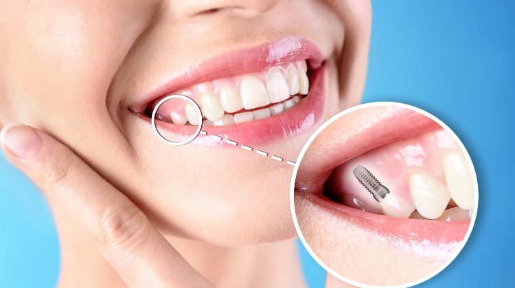 Close-up of a smiling woman with a dental implant illustration, highlighting tooth restoration by Palo Verde Smiles in Glendale, AZ.