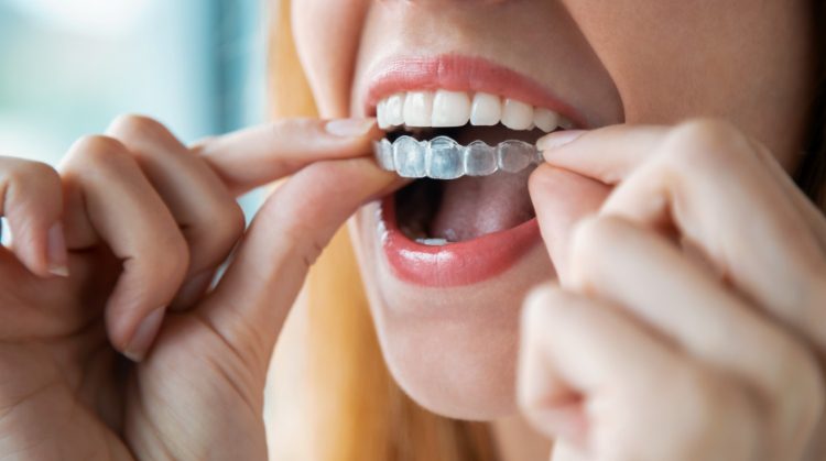 Woman inserting clear Invisalign aligners | Palo Verde Smiles, Glendale, AZ