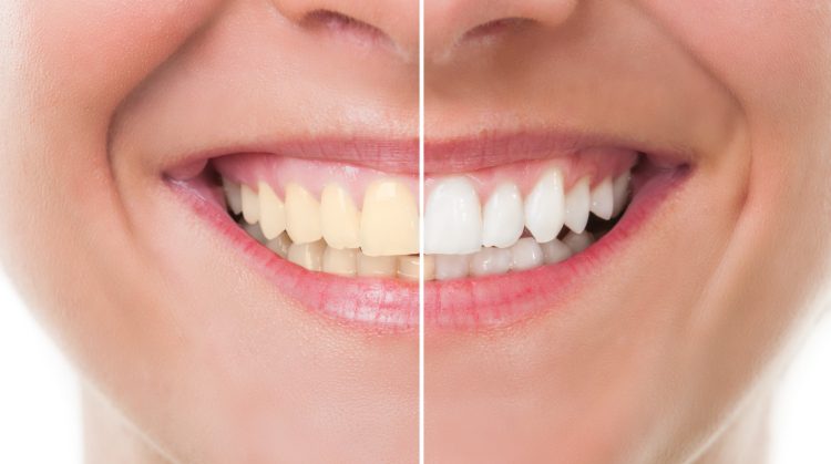 Before and after comparison of a patient's smile showing the results of professional teeth whitening at Palo Verde Smiles in Glendale, AZ — left side shows stained teeth, right side shows bright, white teeth.